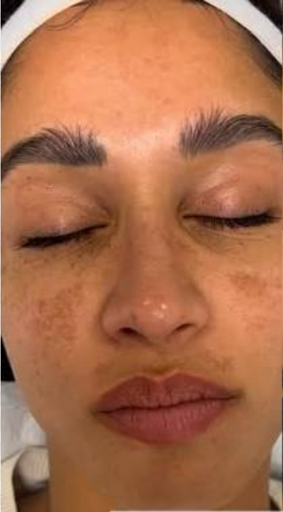 Before - Meera M.