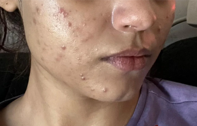 Before - Priya K.